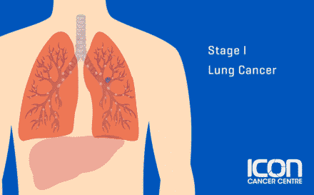 Stage 1 Lung Cancer