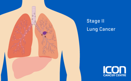 Stage 2 Lung Cancer