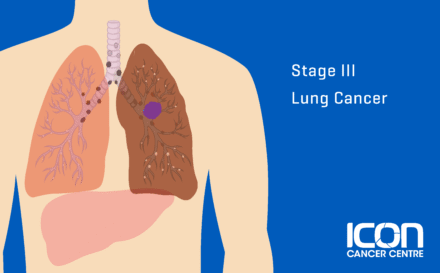 Stage 3 Lung Cancer