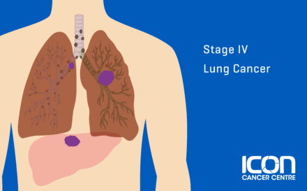 Stage 4 Lung Cancer