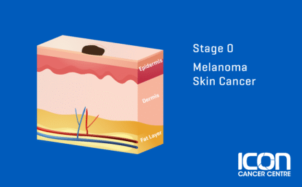 Stage zero Melanoma
