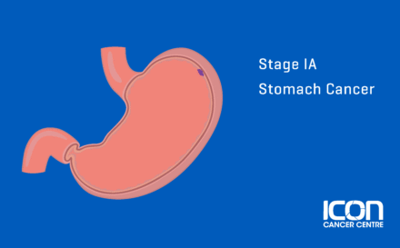 Stage 1a Stomach Cancer