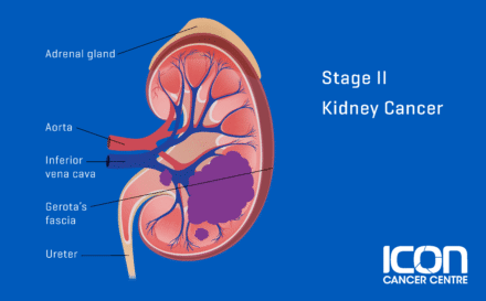 Stage 2 kidney cancer