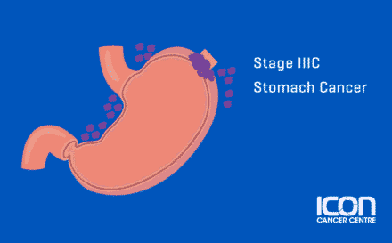Stage 3c Stomach Cancer