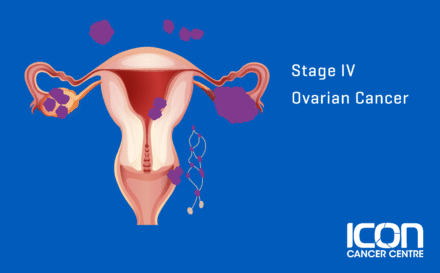 Stage 4 Ovarian Cancer