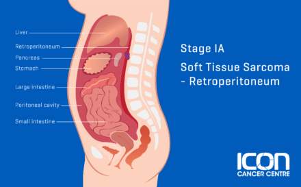 Stage 1a soft tissue sarcoma retroperitoneum